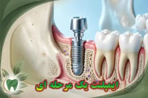 ایمپلنت یک‌مرحله‌ای