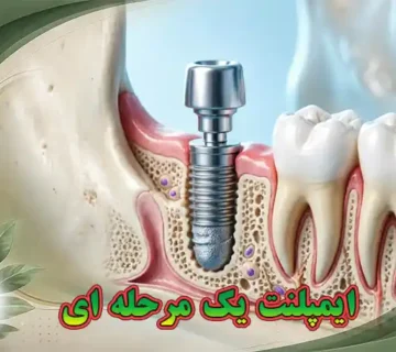 ایمپلنت یک‌مرحله‌ای
