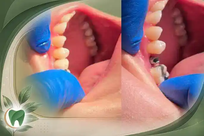 مقایسه قیمت ایمپلنت کره‌ای، آلمانی و سوئیسی